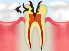 C3（象牙質の虫歯）