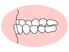 下顎前突 （かがくぜんとつ）