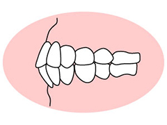 上下顎前突 （じょうげがくぜんとつ）