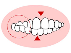 交叉咬合 （こうさこうごう）