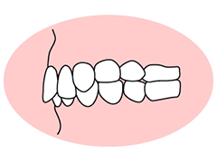 過蓋咬合 （かがいこうごう）