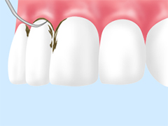 ［治療法］スケーリング