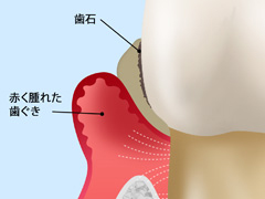 中等度歯周炎