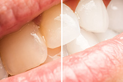 歯の黄ばみは白くできます